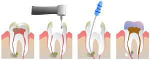 Endodontie2